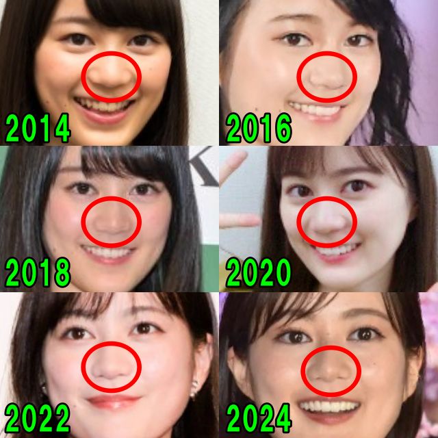 生田絵梨花の2014年から2024年の鼻の比較画像