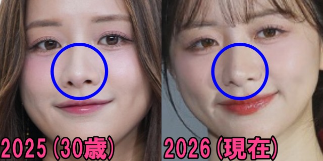 森香澄の2025年と2026年の鼻の画像